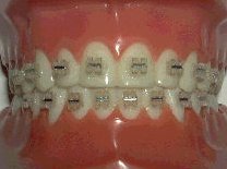 clearbraces.jpg - 7595 Bytes