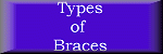 See the Different Types of Braces!!!